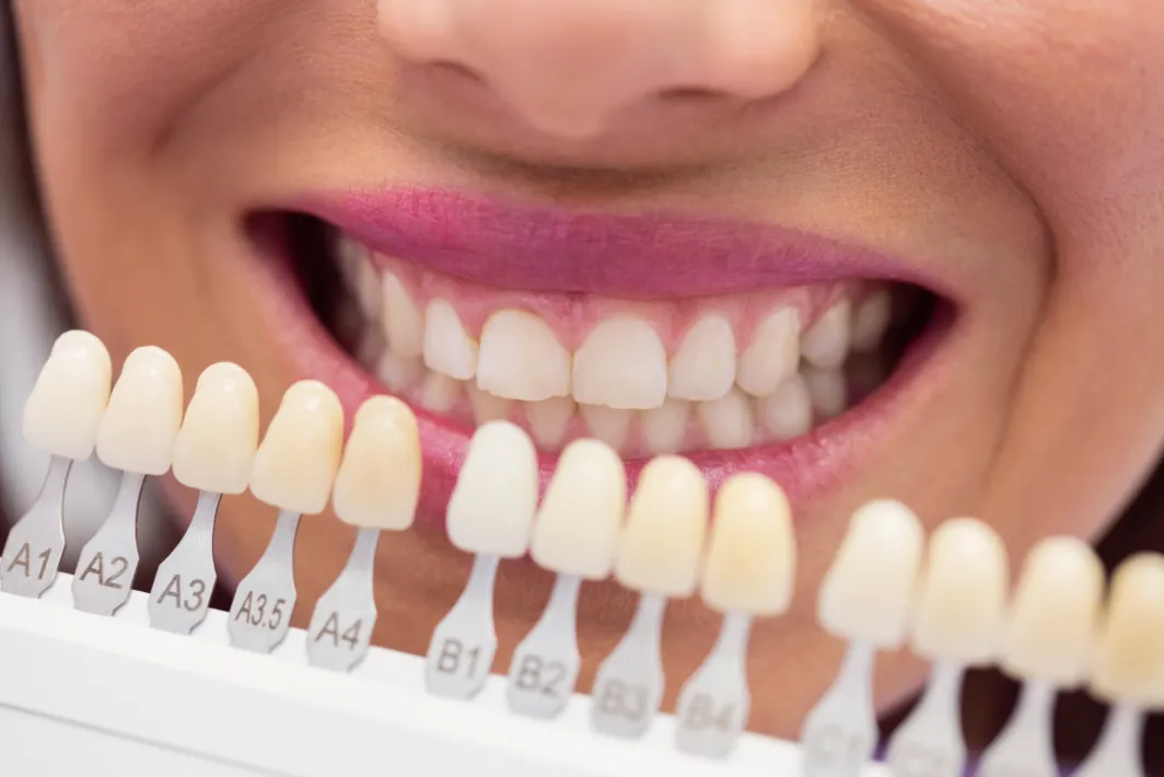 Diş Beyazlatma Öncesi ve Sonrası Dikkat Edilmesi Gerekenler