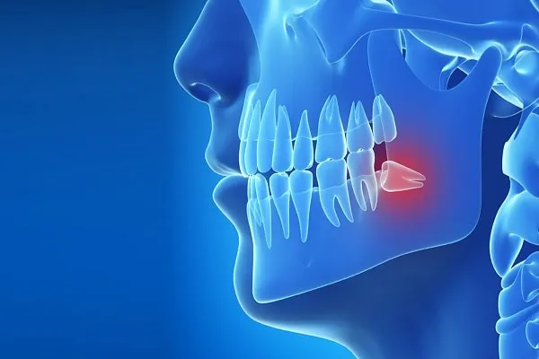 Gömülü Diş Operasyonları: Nedenleri, Süreci ve İyileşme Dönemi