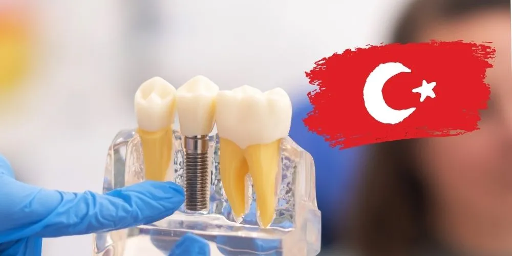 Son yıllarda Türkiye, dünyanın pek çok ülkesinden hastanın tercih ettiği bir implant merkezi oldu. Peki yabancı hastalar neden Türkiye’yi tercih ediyor?