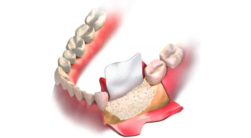 Kemik Erimesi Olanlar